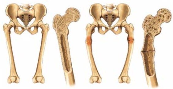 vitamin-d-deficiency-symptoms1-vitaminddeficiencysite-com